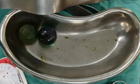 Bé gái 18 tháng tuổi nguy kịch, bác sĩ gắp ra thứ "đáng sợ" trong bụng