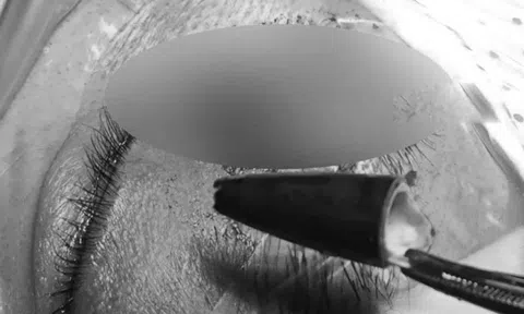 Người đàn ông đau mắt dữ dội, bác sĩ lấy ra thứ "đáng sợ"