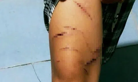 Bé gái lớp 5 nghi bị chị họ dùng dao rọc giấy rạch nhiều vết trên người