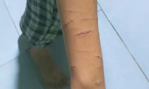 Chị họ lớp 5 rạch tay em bằng dao rọc giấy