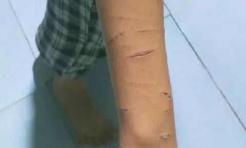 Tin mới vụ chị họ lớp 5 rạch tay em