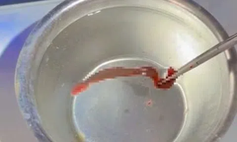 Người đàn ông 53 tuổi chảy máu mũi liên tục, bác sĩ phát hiện ra thứ "đáng sợ" ẩn náu bên trong