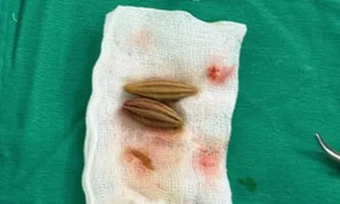 Nuốt nhầm hạt nhót, cụ bà nguy kịch