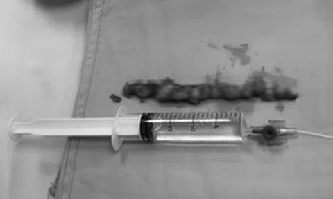 Đau lưng kéo dài tưởng xương khớp, người phụ nữ tá hỏa khi biết mình mắc bệnh nguy hiểm