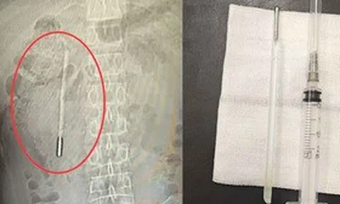 Đau bụng đi khám, người đàn ông sốc nặng khi thấy thứ bên trong