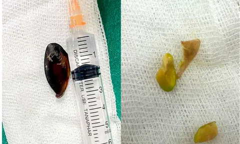 Bé 14 tuổi ho khan kéo dài, gia đình sốc khi bác sĩ lấy ra dị vật bên trong cơ thể