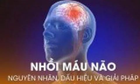 Nhồi máu não: Nguyên nhân, dấu hiệu và giải pháp phòng ngừa từ sớm