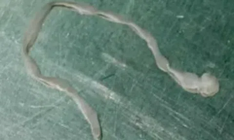 Người phụ nữ lên cơn co giật, bác sĩ lấy ra thứ đáng sợ trong não