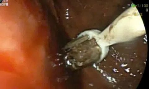 Nam thanh niên 29 tuổi đau bụng, bác sĩ lấy ra thứ "đáng sợ" trong cơ thể