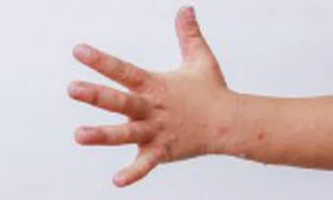 Bệnh tay chân miệng bùng phát và gia tăng nhanh