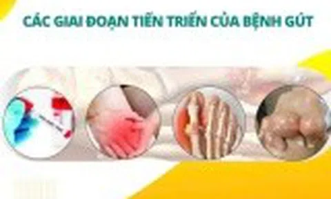 Các giai đoạn tiến triển của bệnh gút