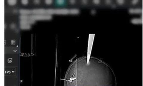 Một phút bất cẩn khi vui chơi, bé 11 tuổi gặp chấn thương nghiêm trọng