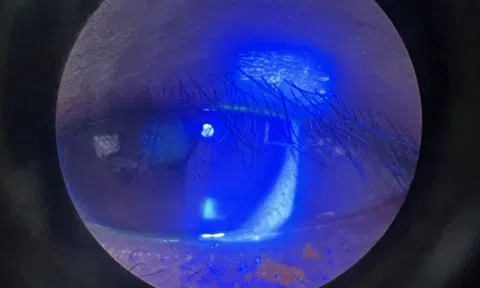 Suýt mất thị lực một mắt vì môn thể thao đang “gây sốt”
