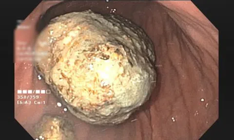 Tưởng đau bụng thông thường, người đàn ông 67 tuổi mang trong mình thứ "đáng sợ" khiến bác sĩ sốc ngang