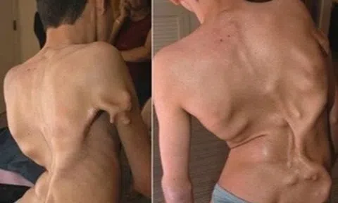 Bé gái 12 tuổi mắc hội chứng "người hóa đá" cực hiếm, cả triệu người mới có một ca