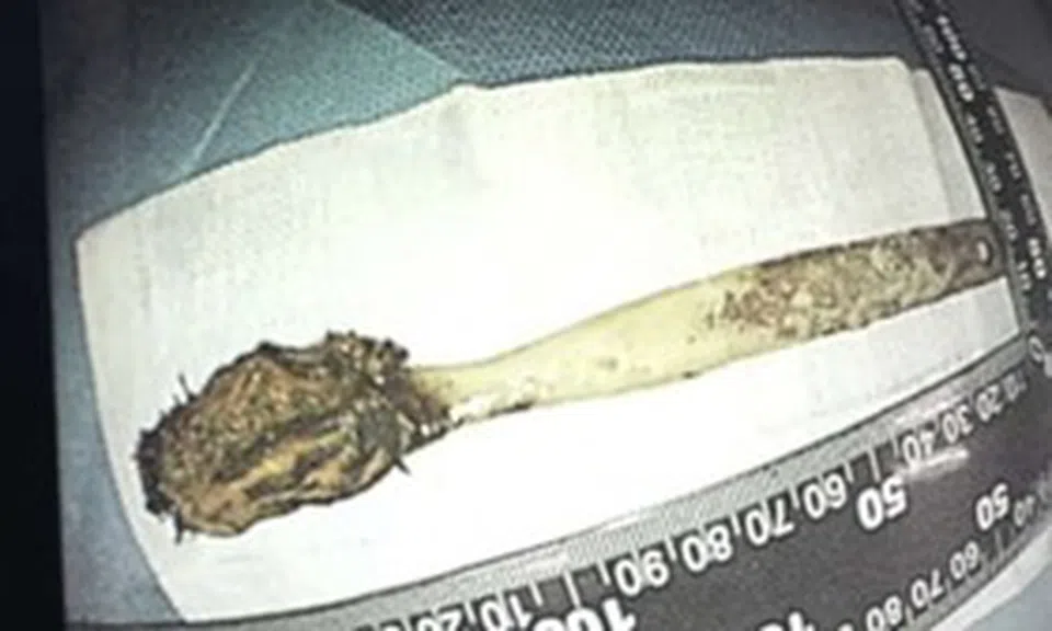 Đau bụng đi khám, người đàn ông "sốc" phát hiện bàn chải nằm trong bụng 52 năm